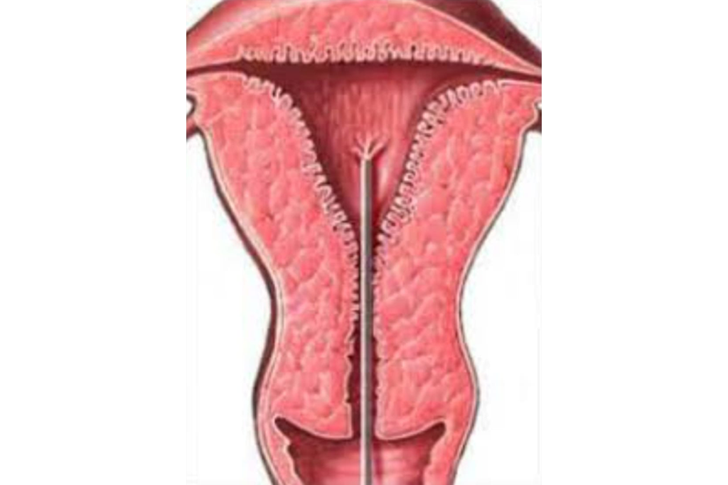 EndometrialReceptivityArray
